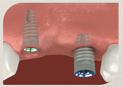 Illustration showing dental implants being placed into the jawbone beneath the gum line, a key step in restoring missing teeth with dental implants.