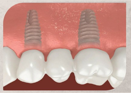 Image showing a custom-made dental bridge being placed onto implants, perfectly matching existing teeth for a seamless and natural-looking smile.