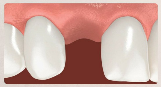 Image showing a single missing tooth in the mouth, highlighting the space where the tooth is absent.