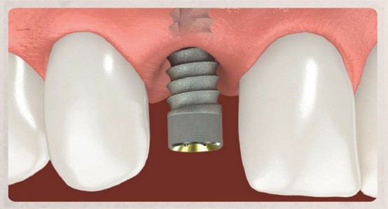 Illustration showing a dental implant being placed into the jawbone beneath the gum line, preparing for the tooth replacement.