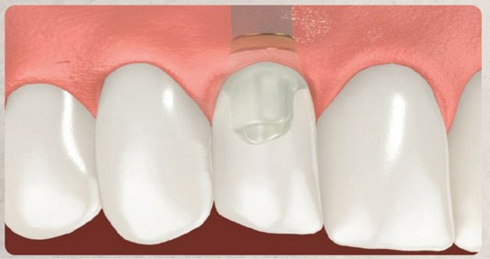 Image showing the abutment and custom-made final crown being placed onto the implant, matching the appearance of surrounding teeth.