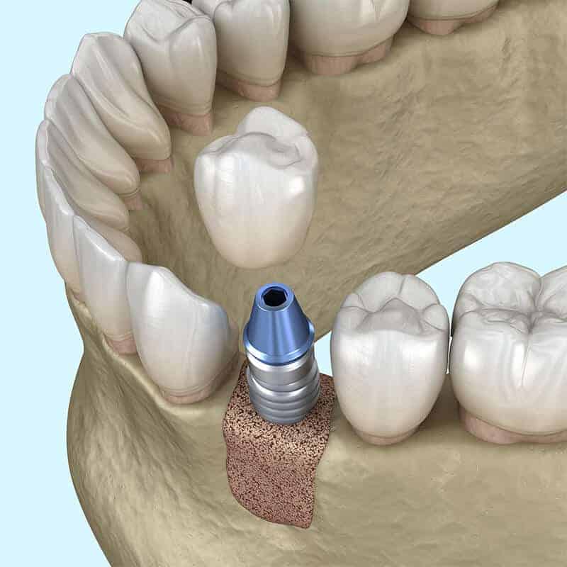 Bone Grafts Full Mouth Dental Implant Memphis Hernando 7852