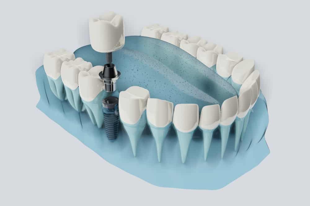 Full Mouth Digital Dental Surgery Memphis Hernando