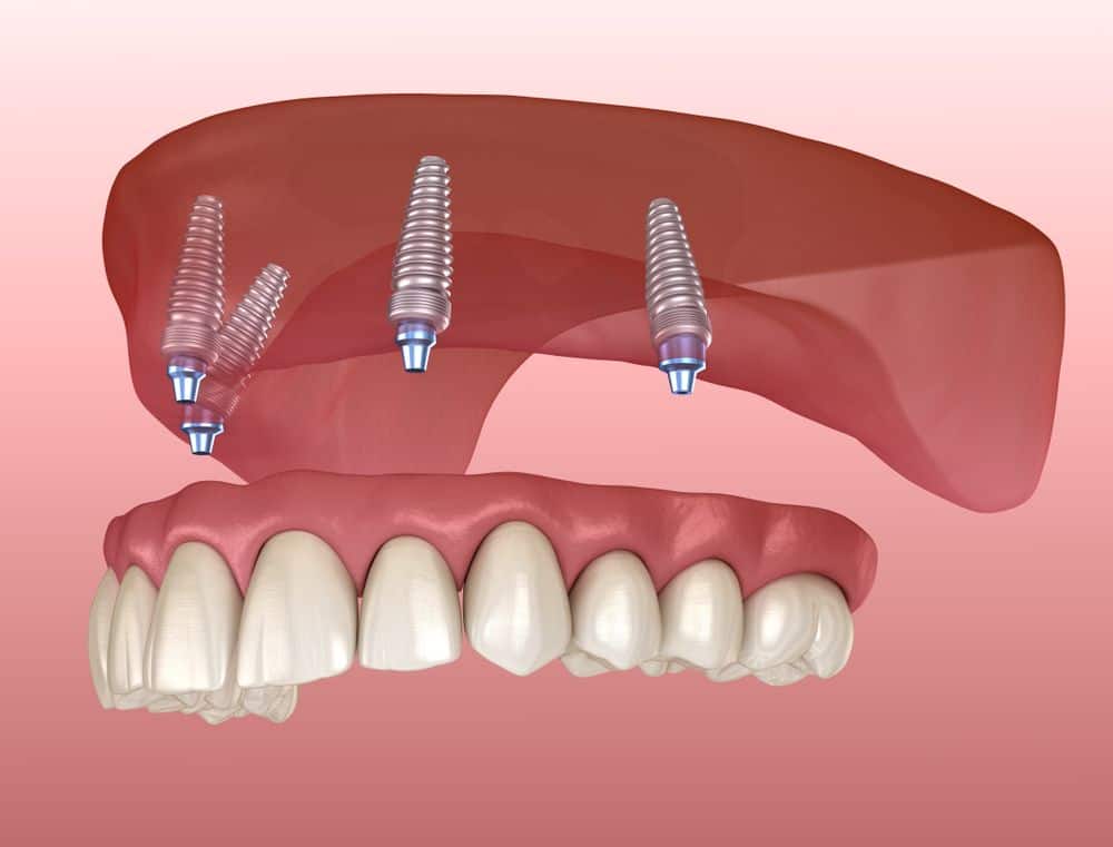 All On Four Implants Snap In Dentures Memphis 