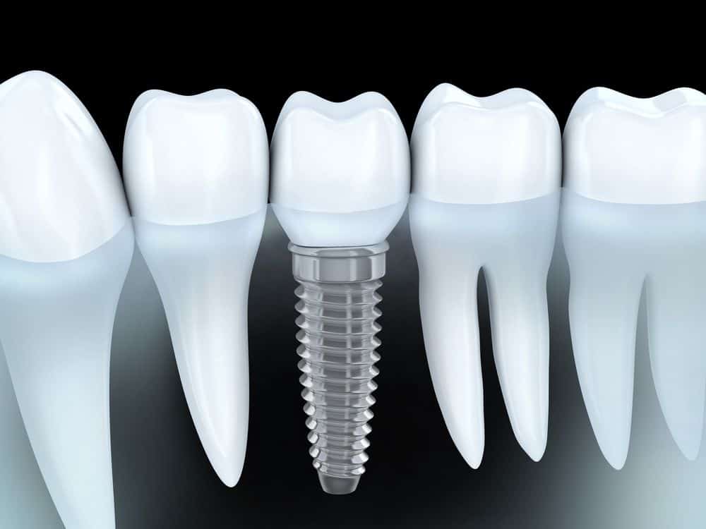  10 Dental Implant Facts You May Not Be Aware Of