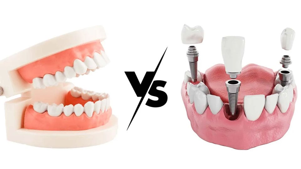  Dental Implants or Dentures