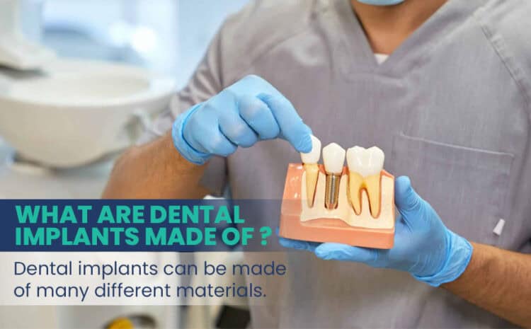  What Are the Best Materials for Dental Implants?