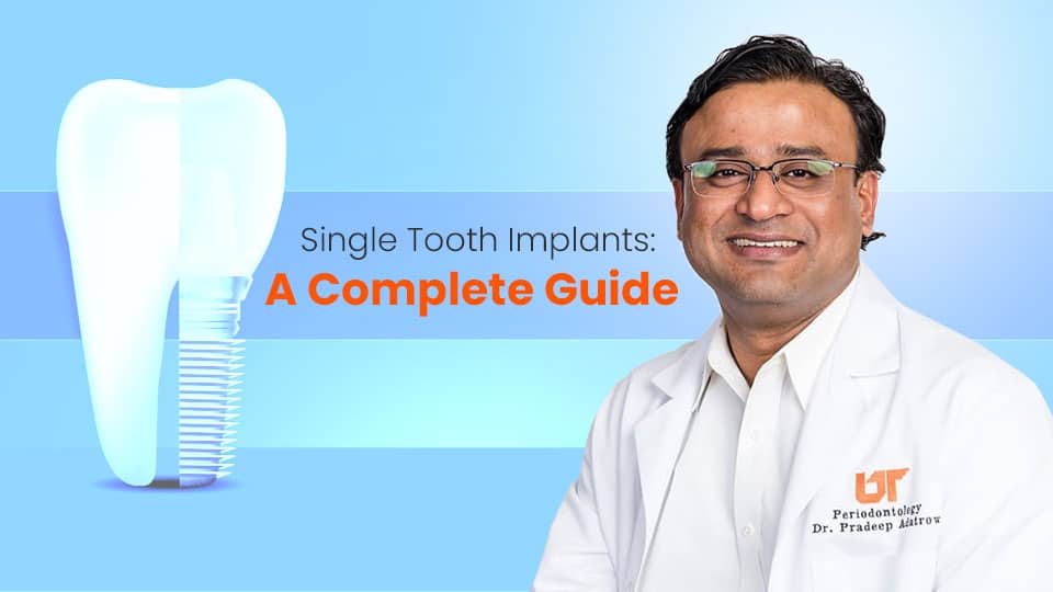  Single Tooth Implants: A Complete Guide