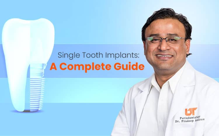  Single Tooth Implants: A Complete Guide