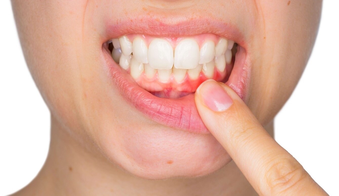 Gum Disease Treatment: Causes, Symptoms, and Expert Care to Prevent Periodontal Disease