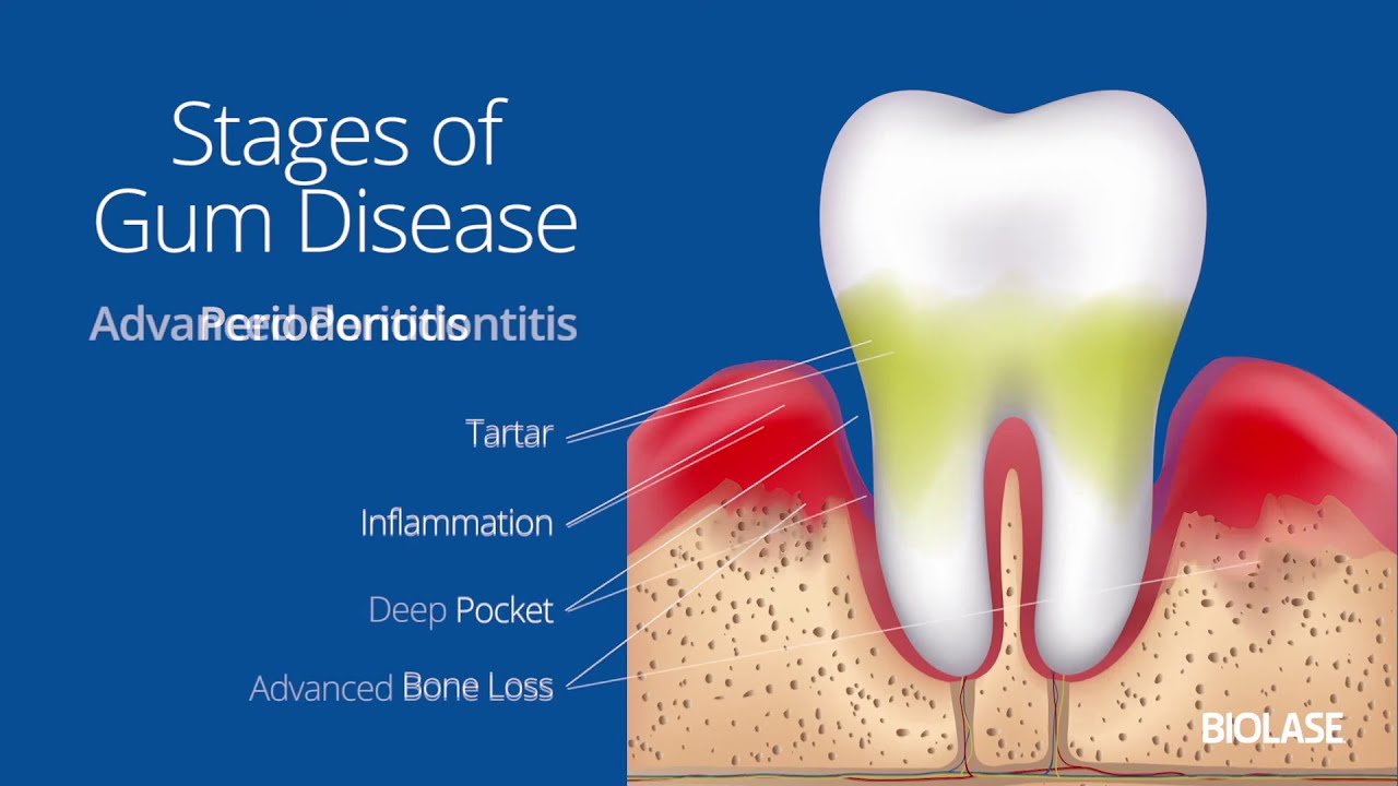  The Early Stage of Dental Implant Complications